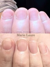 マリーロール 梅田店(Marie Laure)/自爪育成/深爪矯正/ネイルケア