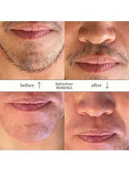 スプランドゥール(Splendeur)/メンズ 髭 光脱毛