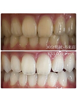 ホワイトニングルーム 川崎店(WhiteningRoom)/ホワイトニング/川崎　