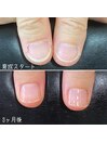 最強のネイルケア3ヶ月コース