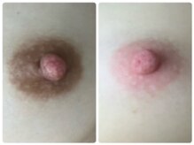 シンボディメイク 恵比寿(SiN BODY MAKE)の雰囲気（ローマピンクバストトップ左Before→右After本来のピンクへ）