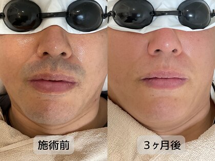 みんなのLED脱毛の写真