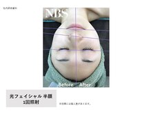 エクラ(E'clat)/光フェイシャル★リフトアップ