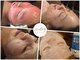 アキュリング(Aculing)の写真