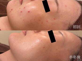 ウォーム(warm)/【肌質改善専門店warm】毛穴洗浄