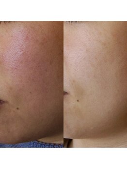 ザ シー タイムレスビューティ(THE SHE)/30代お客様症例写真