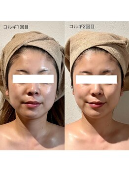 カルナ(CARNA)/綺麗な逆三角形のお顔になれる