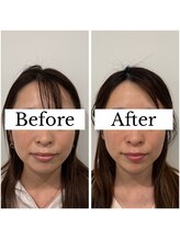 ジョア(joie)/美容鍼施術