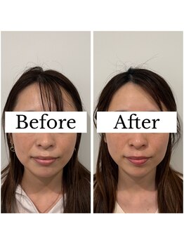 ジョア(joie)/美容鍼施術