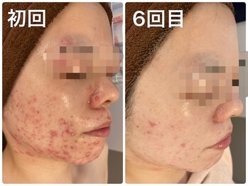 ハオン(HAON)/ハーブピーリング/ニキビ/毛穴