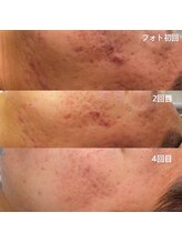 グレイスボディ BiViつくば店(Grace Body)/光フェイシャル症例写真