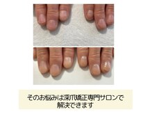 ネイルズシアム/深爪矯正