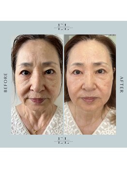 ラプティット(La petite)/60代女性/1回の変化