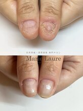 マリーロール 梅田店(Marie Laure)/深爪矯正/自爪育成/自爪風