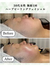 シーフェイス 横浜店(SEE FACE)/肌のハリツヤアップ！くすみ改善