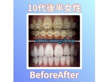 ホワイトニングショップ 西原店/10代後半女性☆BeforeAfter
