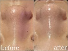 ルテア(Retea.)/徹底毛穴ケア