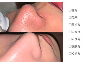 アンシャンテ姫路/顔脱毛全身脱毛　姫路加古川