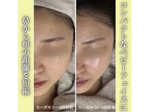 ハニエル(Haniel)/カーボキシー症例