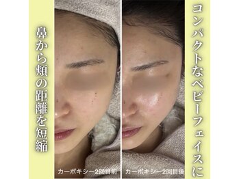 ハニエル(Haniel)/カーボキシー症例