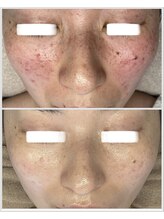 美しぐれ 溝の口/【5回】LDM/LED/酸素ドーム