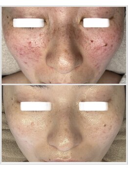 美しぐれ 溝の口/【5回】LDM/LED/酸素ドーム