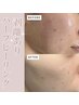 【部分的に剥離☆】剥離なし+剥離ありハーブピーリング