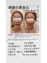 ルリール(Le Rire)/小顔矯正×スノーピール