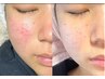 5月～【インディバFaciaｌ/韓国式ハーブピーリング】初心者向け!剥離なし60分