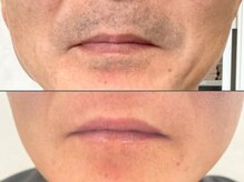 セルフメイド 東大阪店(SELFMADE)/髭脱毛ビフォーアフター【50代】