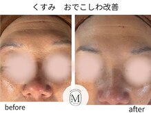 ミヨン(Miyong)/おでこのシワ改善★