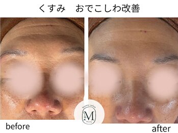 ミヨン(Miyong)/おでこのシワ改善★