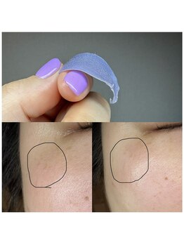 エン(en)の写真/【リピート率9割★】フェイシャルワックス（全顔）+石膏パック+ビタミンC美容液ケア付¥11000！化粧ノリUP☆