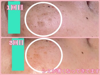 ララン(Laran)/ハイドラ&フォト