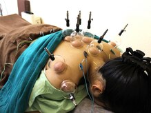 いなほ はりきゅう整骨院 東新宿/鍼灸(吸い玉併用)コース