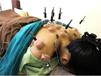 いなほ はりきゅう整骨院 東新宿/鍼灸(吸い玉併用)コース