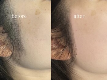 アウル 北千住本店(auL)/【フェイスワックス】もみあげ