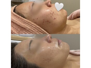 ジャストミービューティー(Just Me Beauty)/ニキビケア