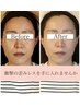 【歪み矯正】左右非対称歪み矯正＋小顔矯正★限定40％off¥5500【顎関節のズレ