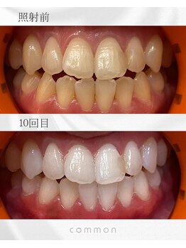 セルフホワイトニングコモン 藤枝店(self whitening common)/10日間ベーシックコース
