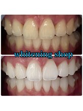 ホワイトニングショップ 明石大久保店/【BeforeAfter】