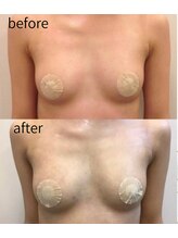 リルマコ/バスト症例写真