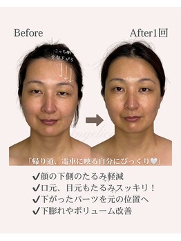 アンジェリカ(Angelica)/1回/ほほのお肉/広がり/顔の歪み