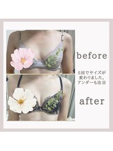 アリサナ(Arisana)/症例写真　葛西　バスト