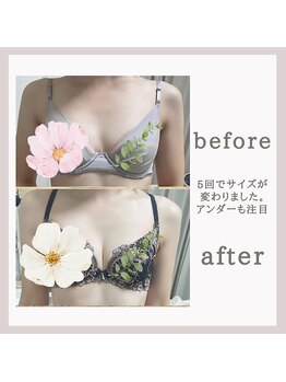 アリサナ(Arisana)/症例写真　葛西　バスト