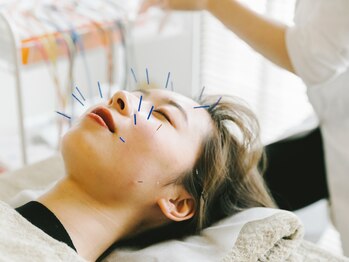アキュネ 福岡薬院店(acune)/福岡/薬院/美容鍼/美肌/小顔