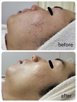 レゾン 京橋店/【ビフォーアフター】ニキビケア