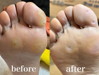 ドクターネイル爪革命 札幌本店/症例紹介16 たこ・うおのめ