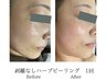 【シリカハーブピーリング】ダウンタイムなし！剥離なしハーブピーリング