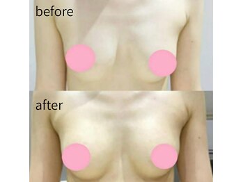 リルマコ/バスト症例写真